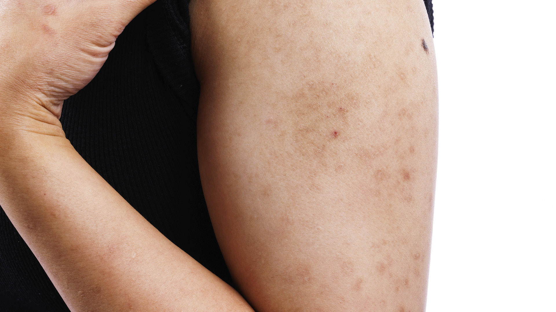 About AD-AD demands a public health response arm eczema