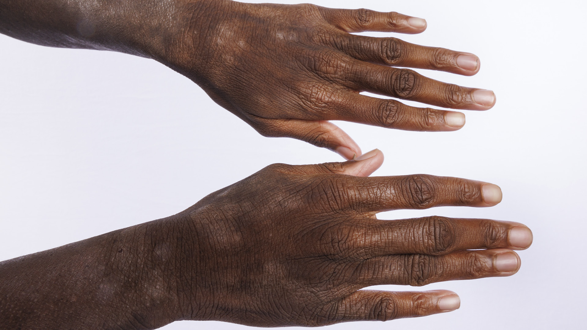 About AD-The most common type of eczema