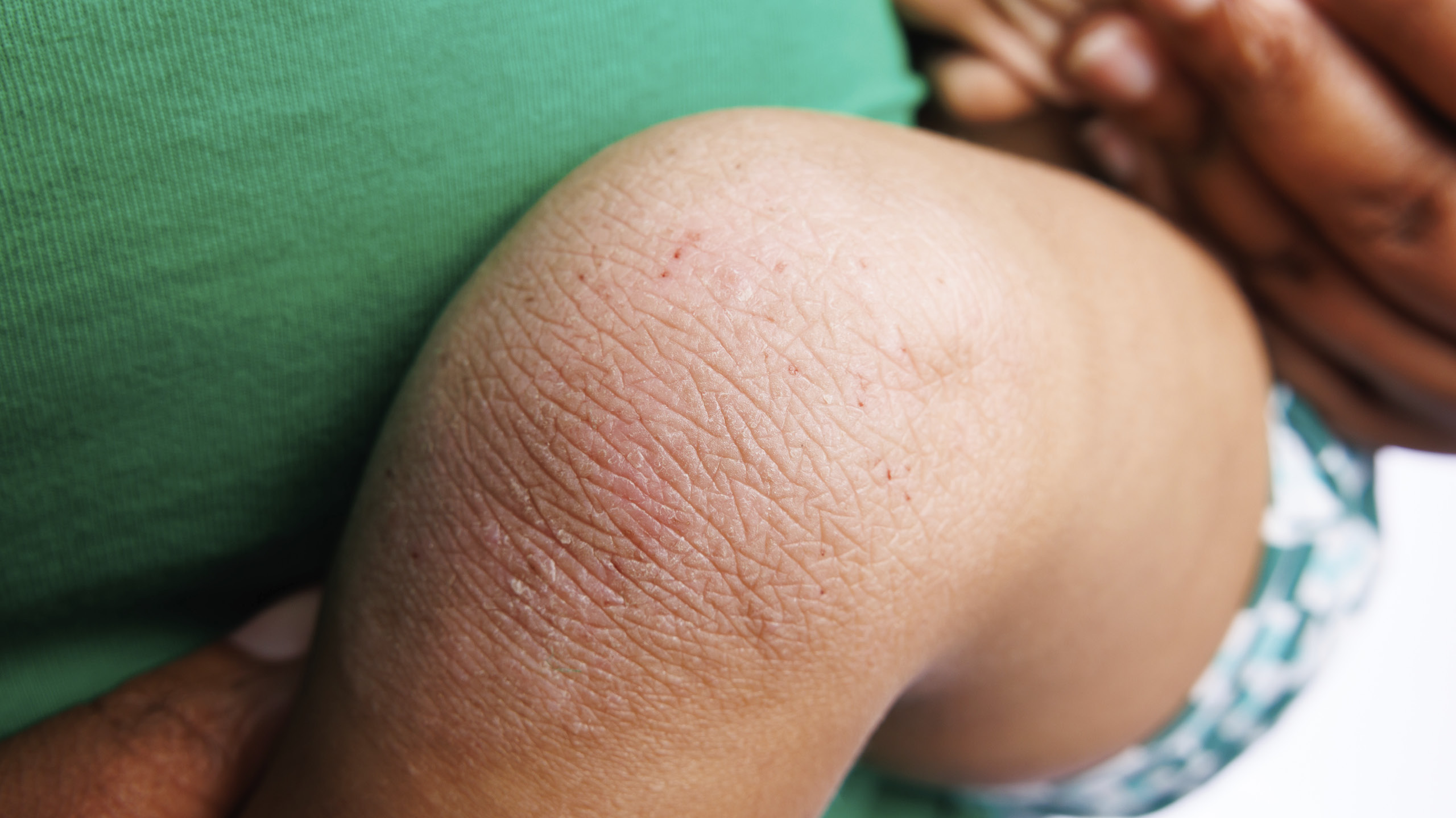 Homepage-Hero13 knee eczema