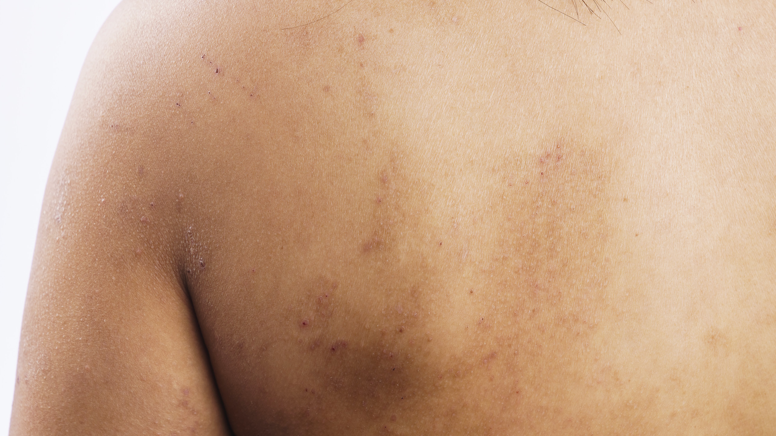 Homepage-Hero14 back eczema