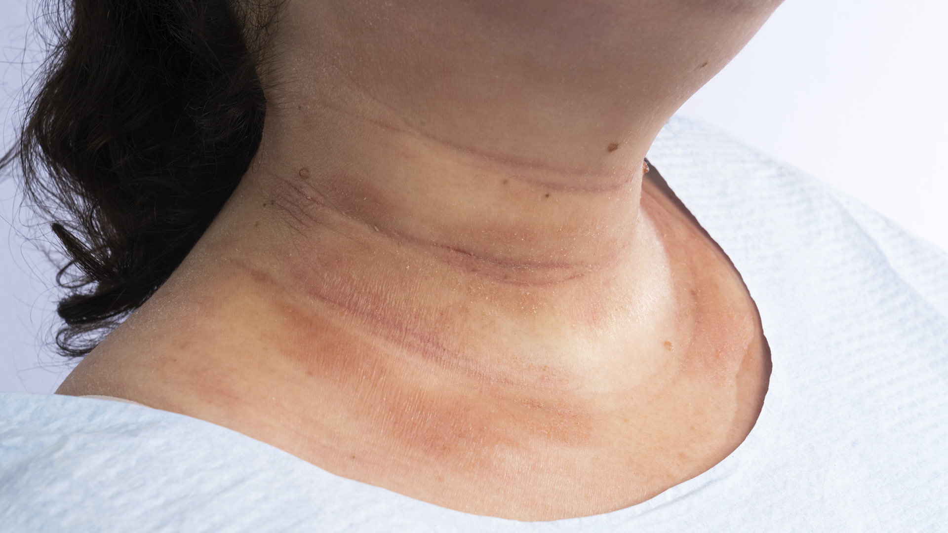 Homepage-body-images neck eczema