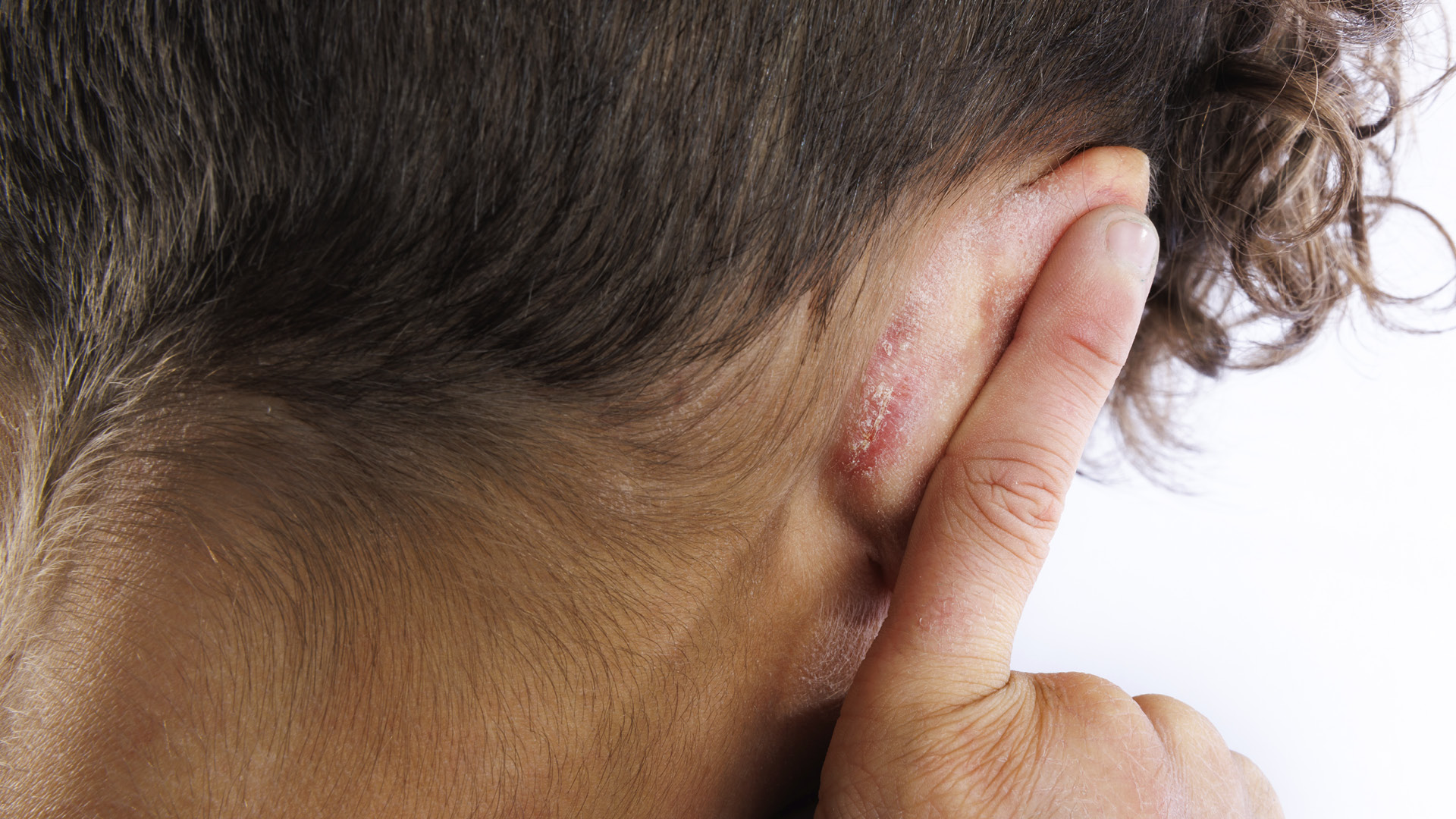 Homepage-body-images3 ear eczema
