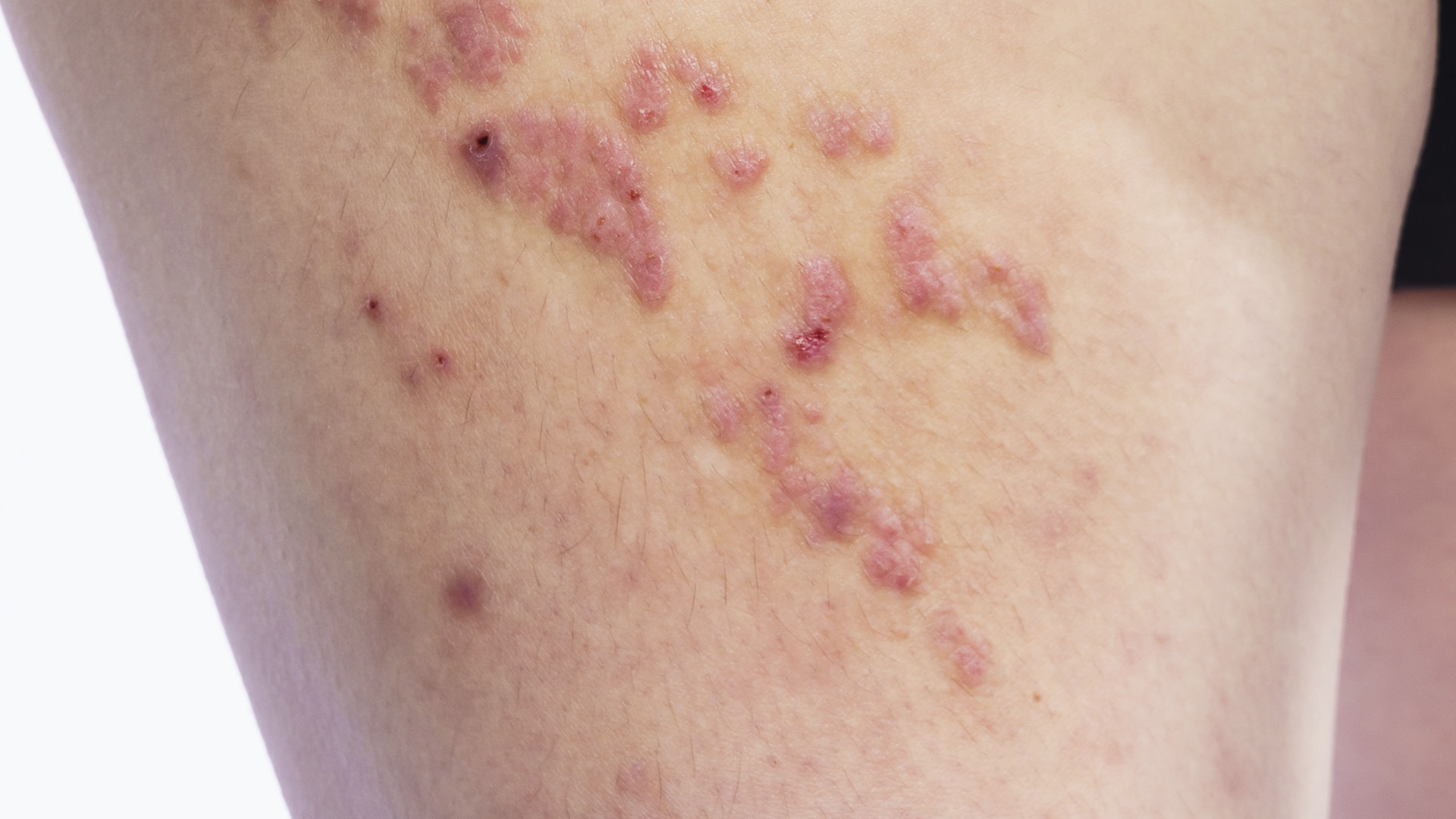 The-State-of-AD-Report_Disease severity