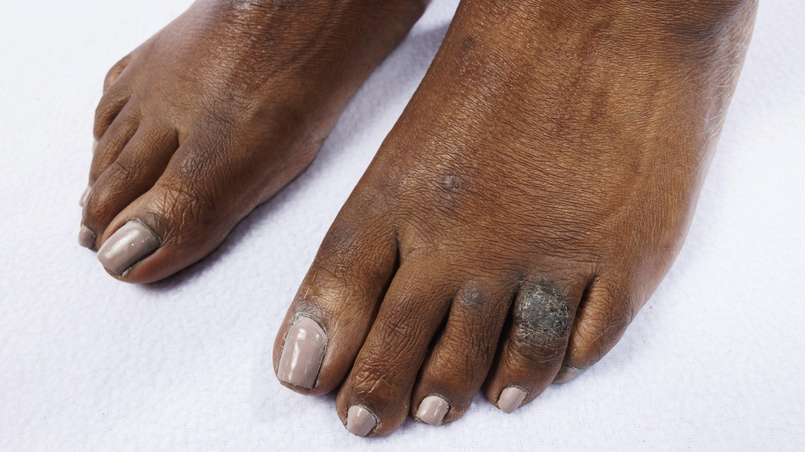 About_AD-AD_demands_a_public_health_response-2 foot eczema