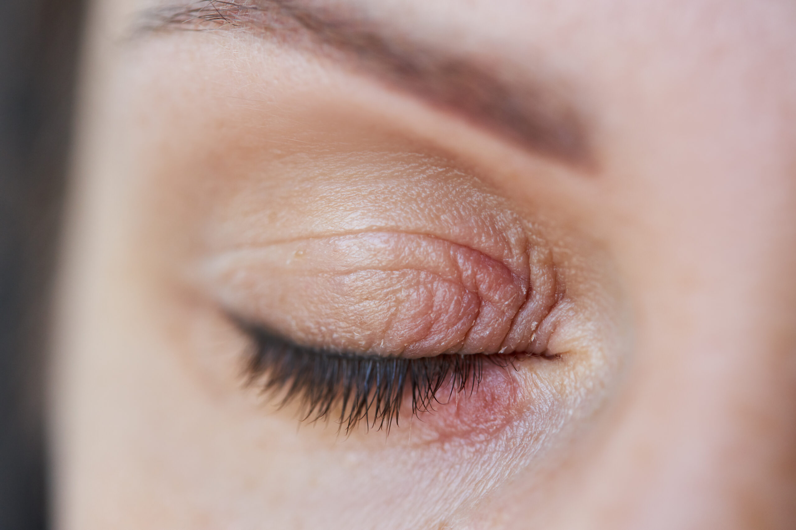 eye eczema