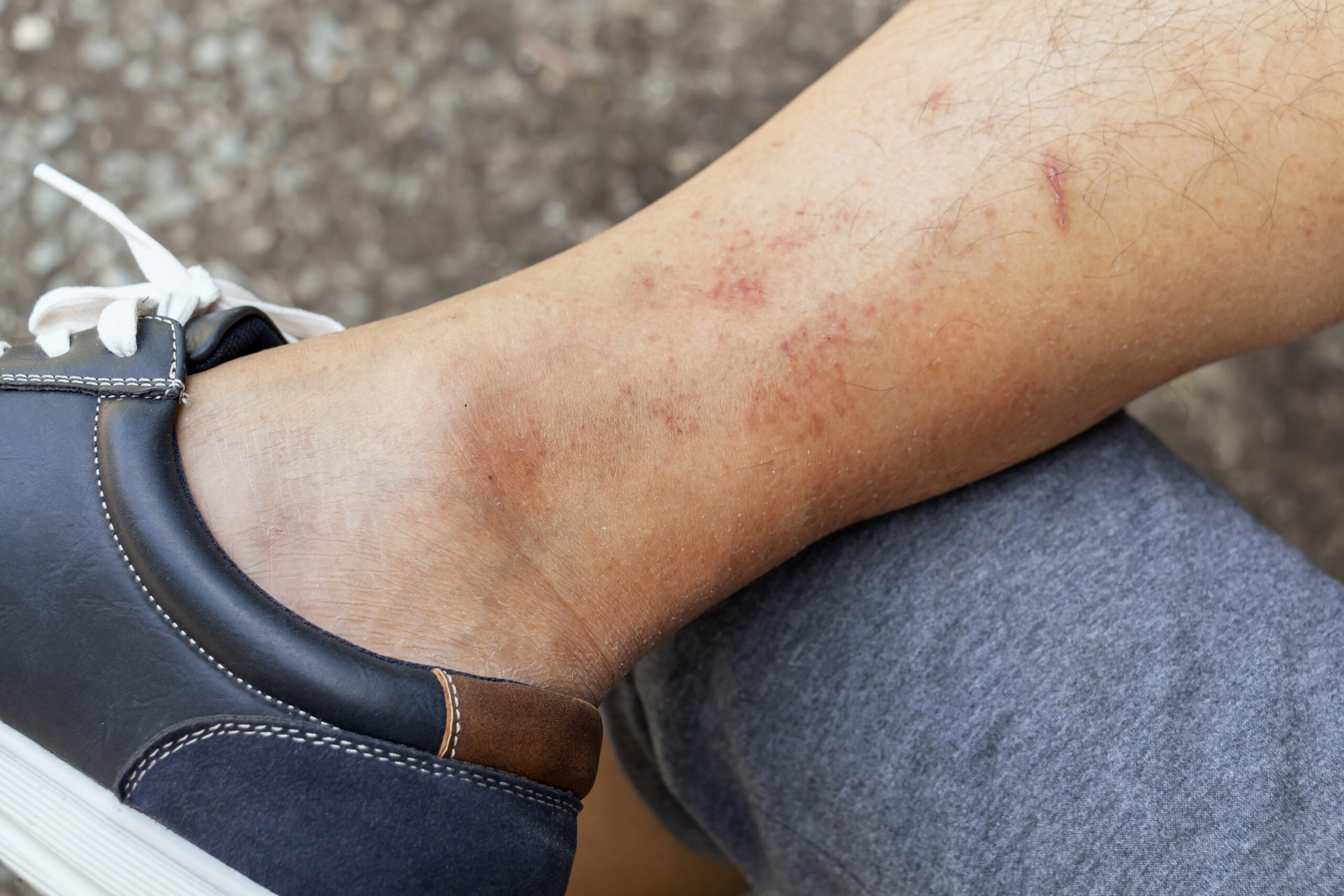 leg eczema