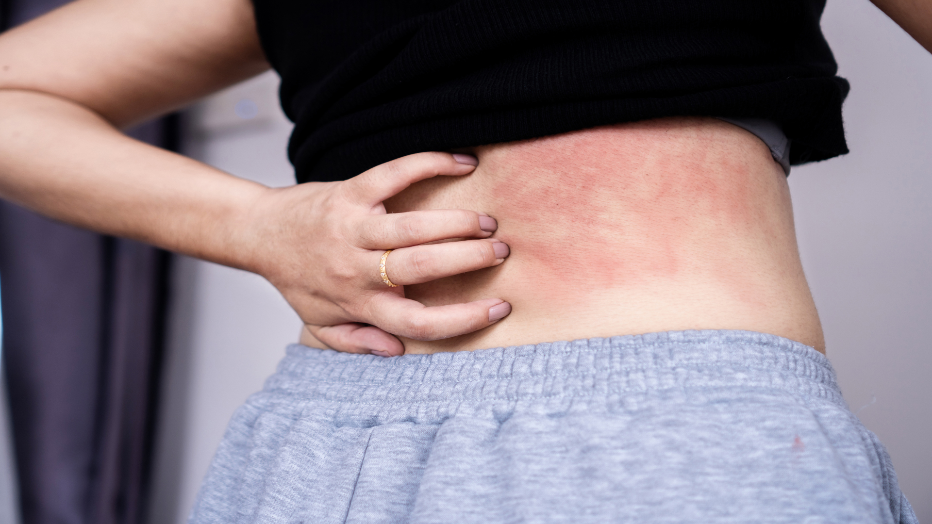 woman suffering from skin disease hand scratching on her itchy back due to allergy to sweat back eczema