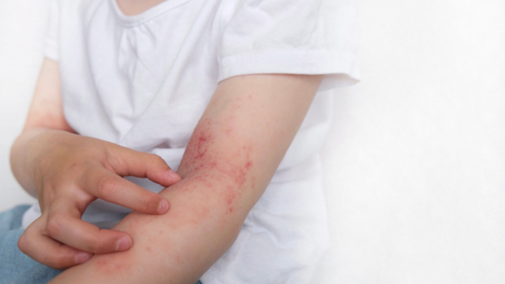 resized-PodcastPedAD_Enews arm eczema
